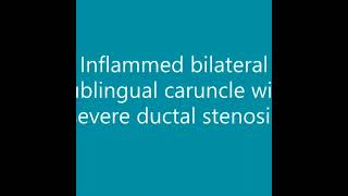 Inflamed Sublingual Caruncle with severe Ductal Stenosis  Dr Nyer Firdoose [upl. by Nodlew]