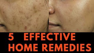 5 EFFECTIVE Home Remedies for Skin Pigmentation Brown Spots and freckles [upl. by Nitnert]