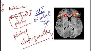 Video 217 Overview of Demyelinating Disorders Clinical Features Diagnostics and Risk Factors [upl. by Kirstin]