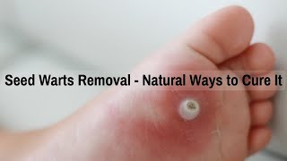 Seed Warts Removal  Natural Ways to Cure It [upl. by Ennaoj]