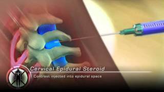 Cervical Epidural Steroid Injection Procedure Animation [upl. by Quent]