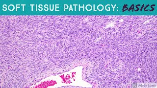 Basic Soft Tissue Pathology Cases Explained by a Sarcoma Pathologist [upl. by Urquhart81]