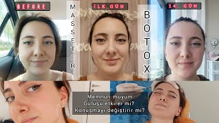 MASSETER BOTOX YAPTIRDIM  ETKİLERİ NELER   1 AYLIK SÜREÇ [upl. by Enilorac]