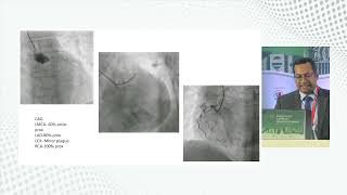 Primary PCI Our experience by Dr Md Arifur Rahman [upl. by Dur376]