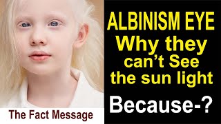 ALBINISM EYE  The hidden Fact [upl. by Paluas735]