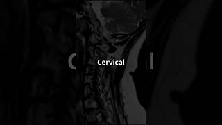 What is Cervical Myelopathy 💥shorts shortsfeed shortsviral [upl. by Cummings]