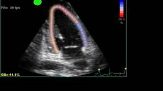 ABNORMAL STRAIN LONGITUDINAL ECHO [upl. by Cart]