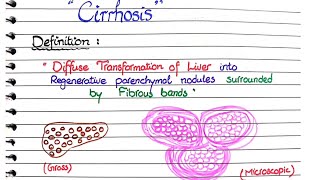 Cirrhosis of Liver  Pathology [upl. by Feeley]