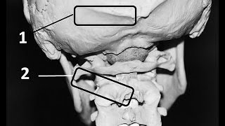 What is Occiptial Neuralgia [upl. by Ellenrahc]