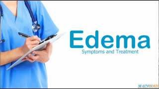 Edema Symptoms and Treatment [upl. by Damiani]