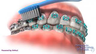 Proper Brushing  Orthodontic Care Instructions [upl. by Sesylu]