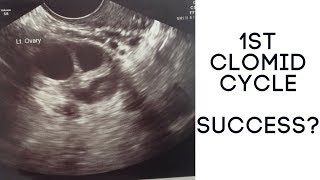 1ST CLOMID CYCLE  SUCCESS  THE RALLS FAMILY [upl. by Ruthe223]