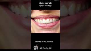 Diastema Closure by composite Resin앞니레진앞니블랙트라이앵글앞니벌어짐벌어진앞니blacktriangle [upl. by Kale]