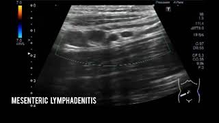 Mesenteric lymphadenitis I Mesenteric lymphadenopathy [upl. by Hueston810]