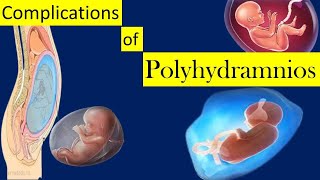 Complications of Polyhydramnios [upl. by Schreib697]