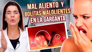 ELIMINA las Bolitas Malolientes de la Garganta y el MAL ALIENTO [upl. by Lleraj991]