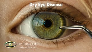 Revolutionizing Dry Eye Treatment Discover Ophthalogixs Eclipse amp Aurora Solutions [upl. by Fachanan]