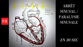 Arythmies  Arrêt sinusal  Paralysie sinusale Shorts [upl. by Eiramassenav584]