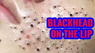 How To Treat a Blackhead On The Lip [upl. by Terrance445]