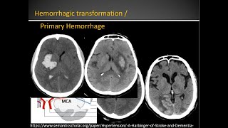 Primary Vs Reperfusion hemorrhage in basal ganglia [upl. by Obaza]