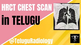 HRCT CHEST SCAN IN TELUGU TeluguRadiology [upl. by Ensoll]