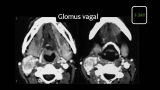 Imaging of Infrahyoid neck part 2 Dr Mamdouh Mahfouz [upl. by Arlen]