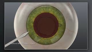 Catalys Laser Cataract Surgery vs Traditional Manual Animation  Cataract Treatment  cataracts [upl. by Mill]