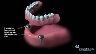 Overdenture Chairside Technique [upl. by Bortz498]