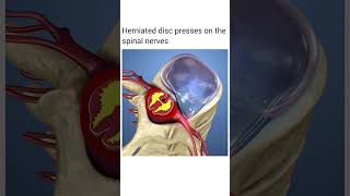 Herniated disk presses on the spinal nerve short [upl. by Milone79]