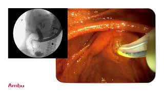 Dr Sam Serouya Performs amp Narrates a Sphincterotomy and Stent Placement Using the aScope™ Duodeno [upl. by Bate103]