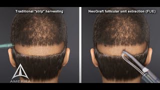 NeoGraft hair transplant procedure  animation [upl. by Nirek]