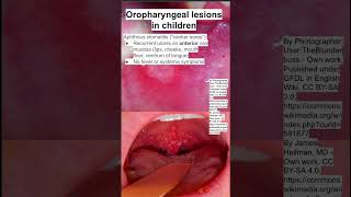 Oropharyngeal lesions in children [upl. by Castor]