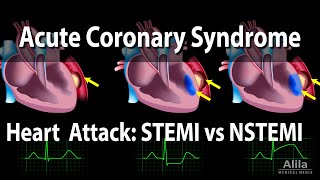 Acute Coronary Syndrome Unstable Angina NSTEMI and STEMI Heart Attack Animation [upl. by Schmitz]