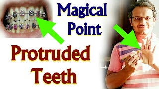 PROTRUDED TEETH Treatment By Acupressure  Single Acupressure Point To CORRECT Protruded UPPER Teeth [upl. by Ceciley]