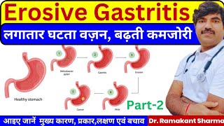 Understanding Erosive Gastritis Causes Symptoms and Management Strategiesdrramakantsharma7 [upl. by Ia922]