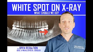 What is the WHITE SPOT on this XRAY How to Evaluate a RADIOPAQUE Lesion  OMFS  Oral Path [upl. by Annagroeg927]