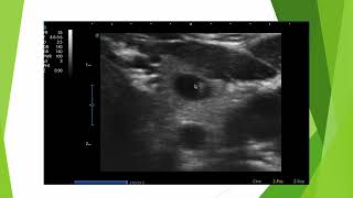 Colloïde versus calcification en échographie thyroïdienne [upl. by Rehpotsrhc994]