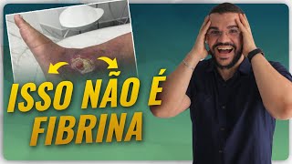 ISSO AQUI NÃO É FIBRINA ENTENDA Fibrina ou Esfacelo [upl. by Pettit470]