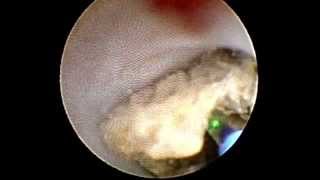 Litotricia ureteral con láser de holmio [upl. by Backer]