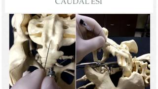 Lumbar Epidural Steroid Injections [upl. by Ten481]