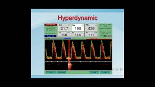 Esophageal Doppler Interpretation [upl. by Nayve627]