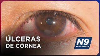 ÚLCERAS DE CÓRNEA  NOTICIERO 9 [upl. by Yup]