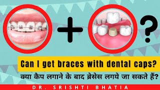 Can I get braces with dental caps or implants Dr Srishti Bhatia [upl. by Arocat]