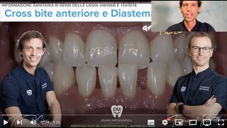 Ortodonzia con allineatori trasparenti Terza Classe Dentale prima dopo mascherine spazi tra i denti [upl. by Devol]