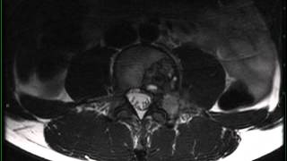 Aneurysmal Bone Cyst secondary to osteoblastoma [upl. by Marice440]