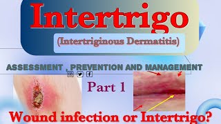 IntertrigoIntertriginous Dermatitis Assessment  Prevention and Management [upl. by Mccreary432]