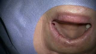 241002 Flapless implant placement in posterior maxillla1 [upl. by Senalda]