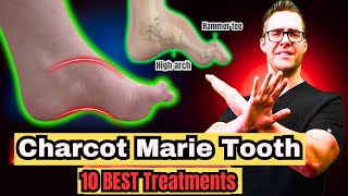 Charcot Marie Tooth Disease Top 10 Treatments [upl. by Gmur]