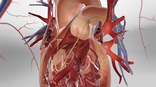 Pulmonary Artery Catheterization 3D Animation [upl. by Jae395]