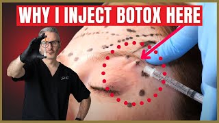 How To Inject Botox Under The Brow  Botox Brow Lift Advice [upl. by Arlee581]